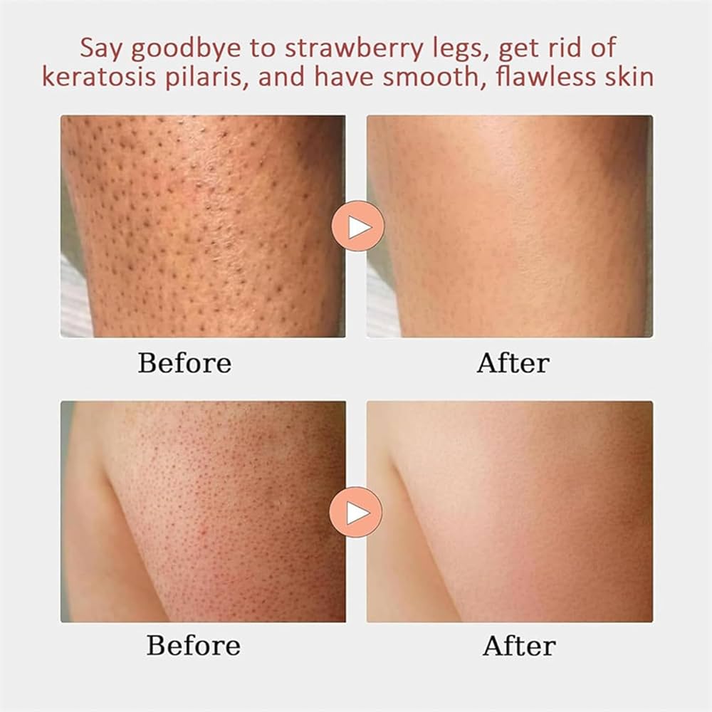 Keratosis Pilaris Bump Flattening Cream