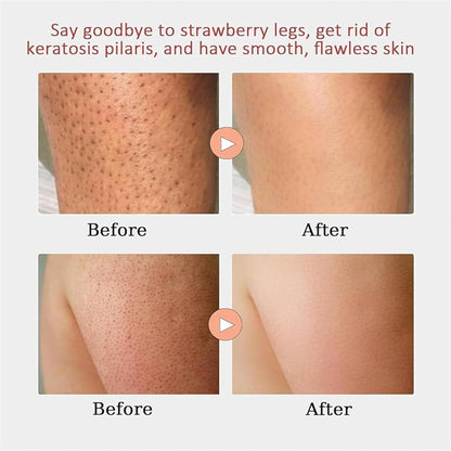 Keratosis Pilaris Bump Flattening Cream