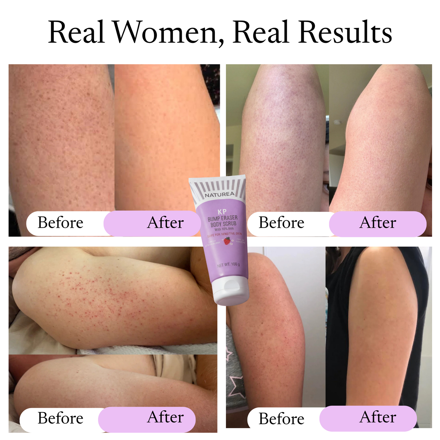 Keratosis Pilaris Bump Flattening Cream