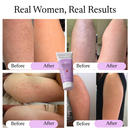 Keratosis Pilaris Bump Flattening Cream