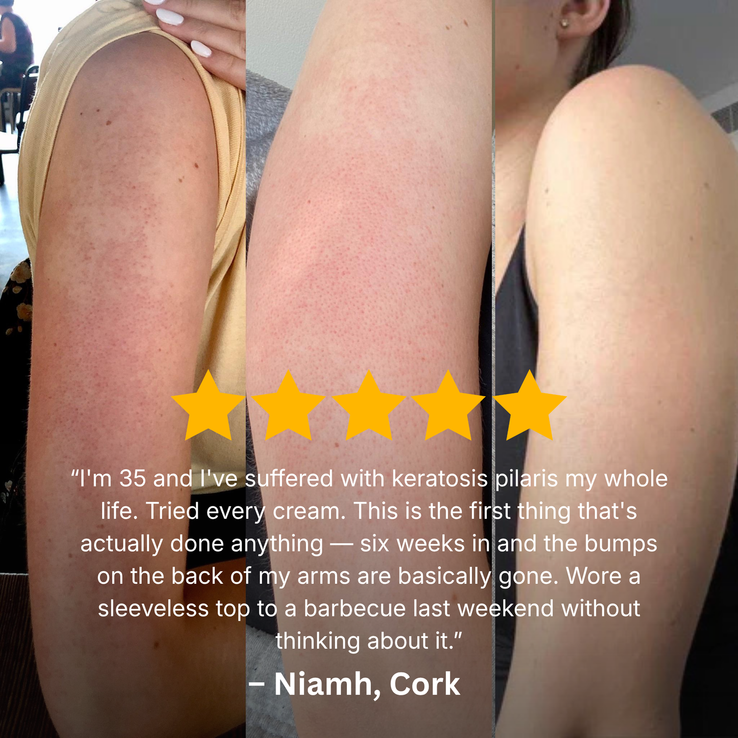 Keratosis Pilaris Bump Flattening Cream