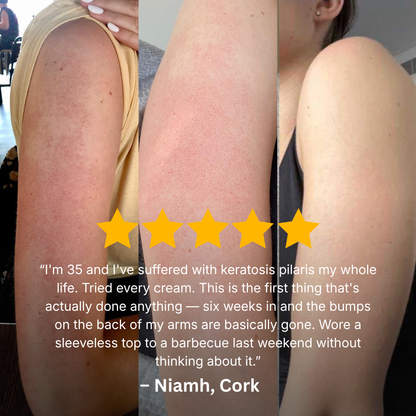 Keratosis Pilaris Bump Flattening Cream