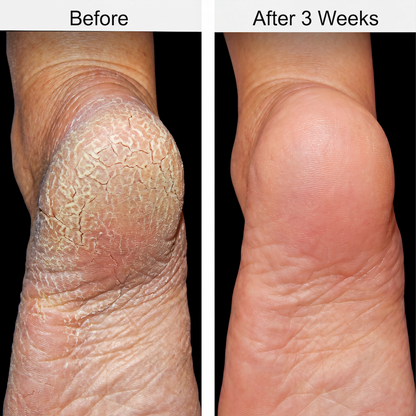 Urea & Salicylic Acid Foot Care Stick